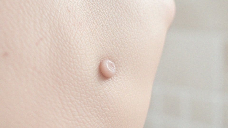 Kaszaki a tłuszczaki – różnice, objawy i metody leczenia