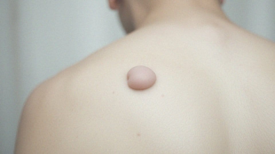 Twardy guz na plecach – co musisz wiedzieć i kiedy działać?